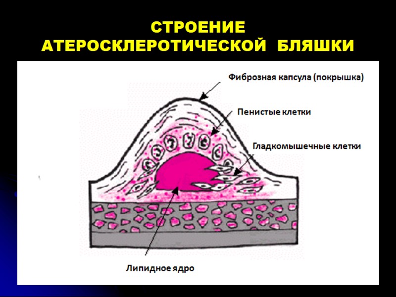 СТРОЕНИЕ  АТЕРОСКЛЕРОТИЧЕСКОЙ  БЛЯШКИ